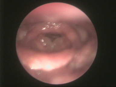 Oedema chr. pl. voc bil.