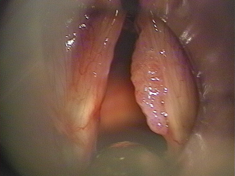 Прелазни облик кој и локализацијом подсећа на локализовани а изгледом на дифузни облик 